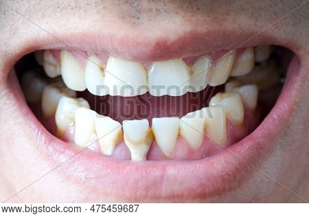 Tooth's A Man Smoking Bad. Man Smokes A Cigarettes Have Tooth Decay And Calculus On Teeth, So We Sho