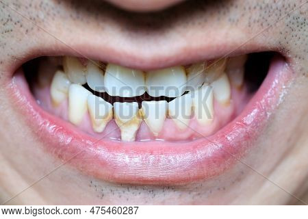 Tooth's A Man Smoking Bad. Man Smokes A Cigarettes Have Tooth Decay And Calculus On Teeth, So We Sho