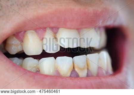 Tooth's A Man Smoking Bad. Man Smokes A Cigarettes Have Tooth Decay And Calculus On Teeth, So We Sho