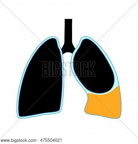 Chylothorax Disease. Lymphatic Fluid Between Layers Of Tissue In Lungs And Chest Wall. Severe Cough,