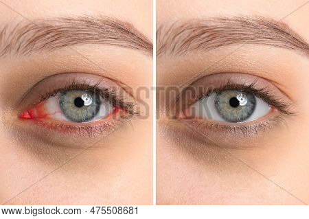 Collage With Photos Of Woman Before And After Conjunctivitis Treatment, Closeup Of Eye