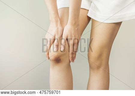 Close Up Of Stain Bruise Wound On Leg, Contusion Asian Young Woman, Girl On Joint Knee From An Accid
