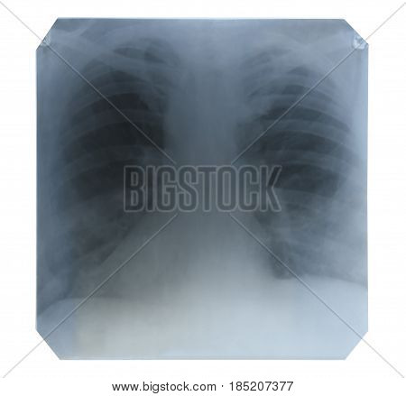 X-ray picture of lungs (chest) isolated on white background