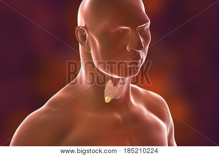 Thyroid cancer. 3D illustration showing thyroid gland with tumor inside human body