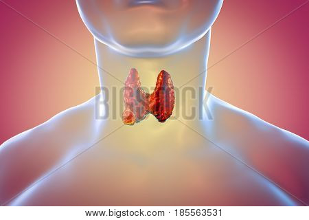 Thyroid cancer. 3D illustration showing thyroid gland with tumor inside human body