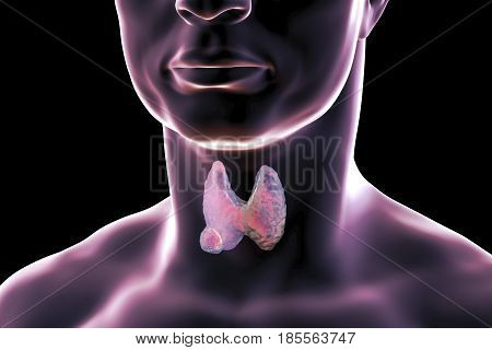 Thyroid cancer. 3D illustration showing thyroid gland with tumor inside human body