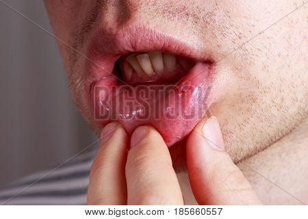 Stomatitis on the lips of a man