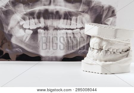 Dental Casting Gypsum Model Of Human Jaws With Panoramic Dental X-ray . Crooked Teeth And Distal Bit
