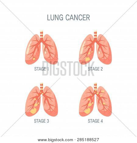 Strages Of Lung Cancer Concept. Vector Illustration In Flat Style For Medical Articles, Posters, Web