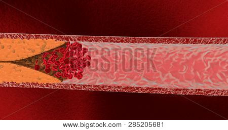 Blocked Blood Vessel. Artery With Cholesterol. 3d Render