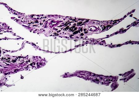Histopathology Of Lung Emphysema, Light Micrograph, Photo Under Microscope Showing Enlargement Of Ai