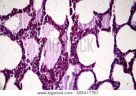 Histopathology Of Pneumonia, Light Micrograph, Photo Under Microscope. Cellulose Aspiration Pneumoni