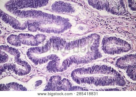 Histopathology Of Intestinal Adenoma, Light Micrograph, Photo Under Microscope