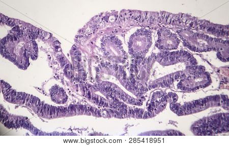 Histopathology Of Intestinal Adenoma, Light Micrograph, Photo Under Microscope