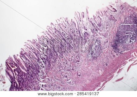 Histopathology Of Chronic Atrophic Gastritis, Light Micrograph, Photo Under Microscope