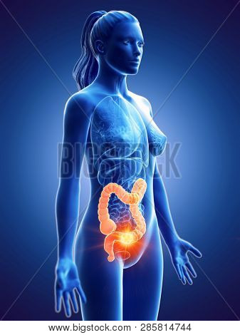 3d rendered medically accurate illustration of a womans colon cancer