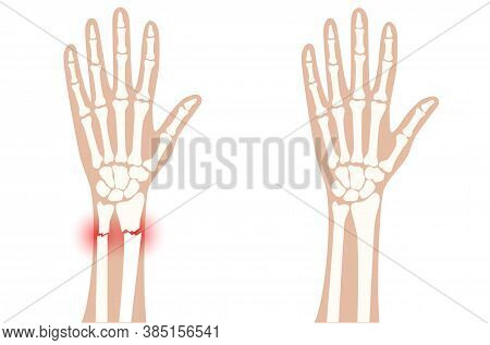 X Ray Of Arm Fracture With Red Pain Points And Normal Arm. Broken Hand With Inner Closed Radius Type