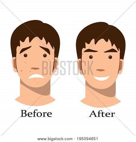 Boy acne treatment before and after. Vector illustration