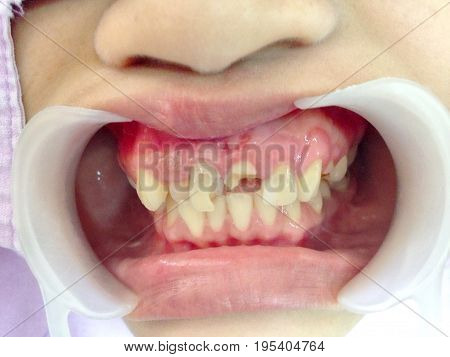 Front teeth broken by accident  checked up by the dentist