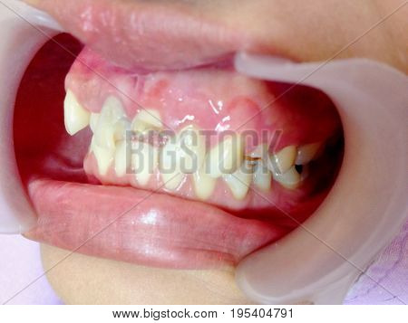 Front teeth broken by accident  checked up by the dentist