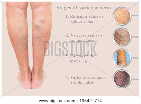 Varicose veins on a female senior legs. The stages of varicose veins