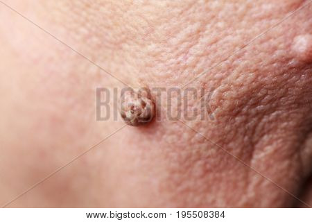 Details of senior woman face. Elderly pensioner female dermal fibroma close up.