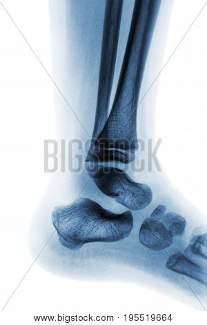 Film x-ray of normal child ankle . Lateral view .