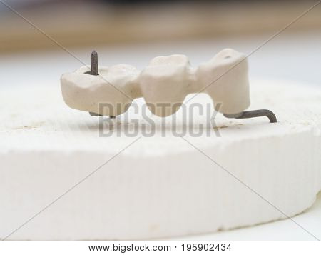 Mplants Teeth Made In The Technic Opaque Porcelain Dental. Oxidized Metal Opaque.