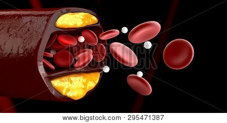 3d Illustration Of Blood Cells With Plaque Buildup Of Cholesterol Isolated Black