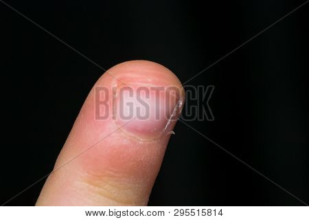 Kid Finger Peak On Black Background With Exfoliated Skin Around The Nail