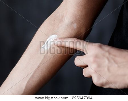 Vitiligo Close-up On Hands And Elbows. Man Smears Pigment Cream. Cares For The Skin. Vitiligi Treatm