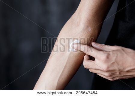 Vitiligo Close-up On Hands And Elbows. Man Smears Pigment Cream. Cares For The Skin. Vitiligi Treatm