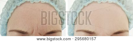 Woman Wrinkles Face Before And After Correction Procedures, Anti Aging