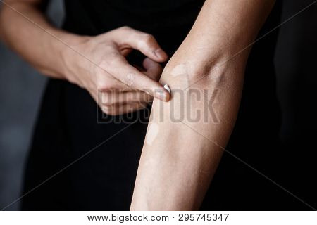 Vitiligo Close-up On Hands And Elbows. Man Smears Pigment Cream. Cares For The Skin. Vitiligi Treatm
