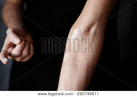 Vitiligo Close-up On Hands And Elbows. Man Smears Pigment Cream. Cares For The Skin. Vitiligi Treatm
