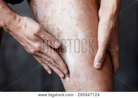 Vitiligo Close-up On The Legs Of A Man. A Young Guy Cares For The Skin, Smears The Skin With Pigment