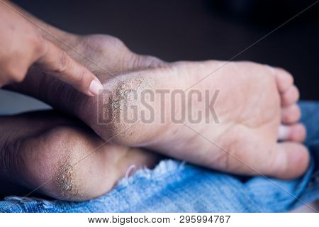 Cracked Heels,hands And Heels Cracked,concept Health,body Care Concept