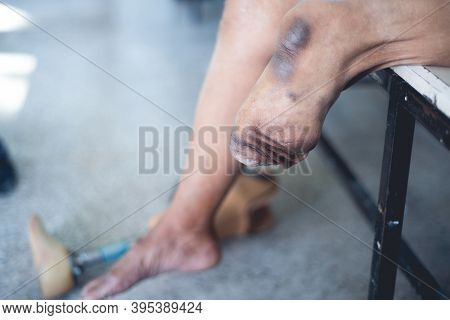Below Knee Amputee Patient With Muscle Training For Prosthesis