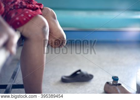 Below Knee Amputee Patient With Muscle Training For Prosthesis