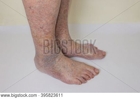 Close-up Of Skin With Varicose Veins On Senior Male Leg. Concept Of Dry Skin