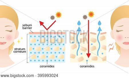 Dry And Hydrated Skin Layer With Ceramide And Woman Illustration. Beauty And Skin Care Concept
