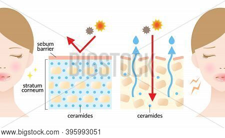 Dry And Hydrated Skin Layer With Ceramide And Woman Illustration. Beauty And Skin Care Concept