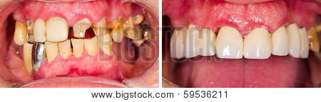 Denture Before And After Treatment