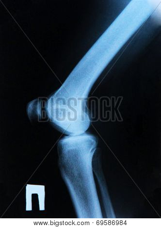 Knee X-ray
