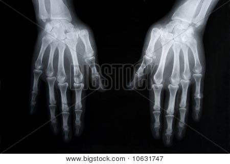Röntgenbild aus Menschenhand