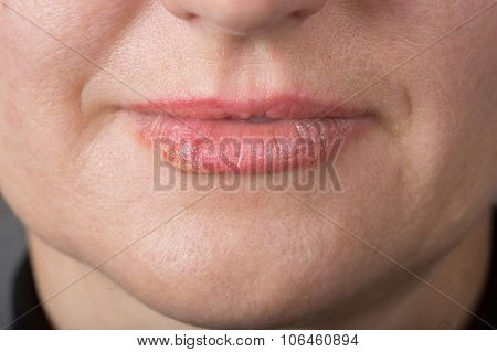 Lip infection with the herpes virus