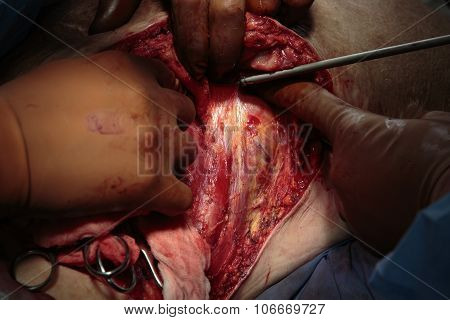 Back Muscles During Surgery