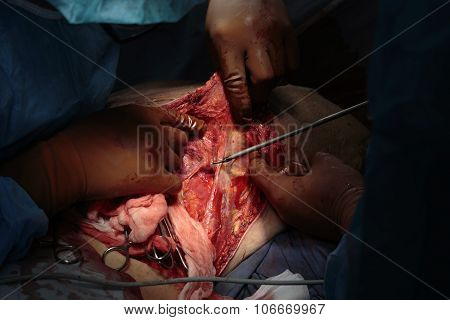 Complex Back Surgery