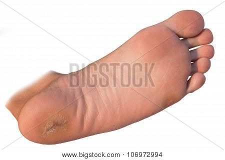 foot corn closed-up