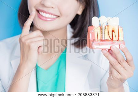 woman dentist take implant tooth and touch tooth on the blue background